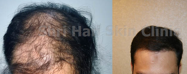 Body Hair Transplant in Surat  Dr Smart Clinic